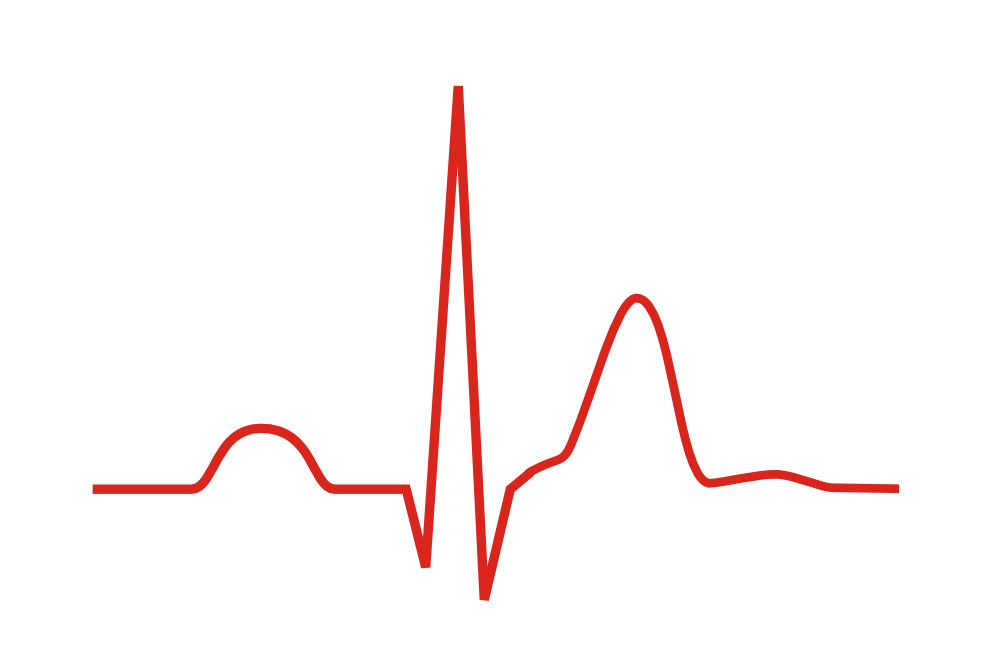 Una onda de ECG que muestra un intervalo QT acortado